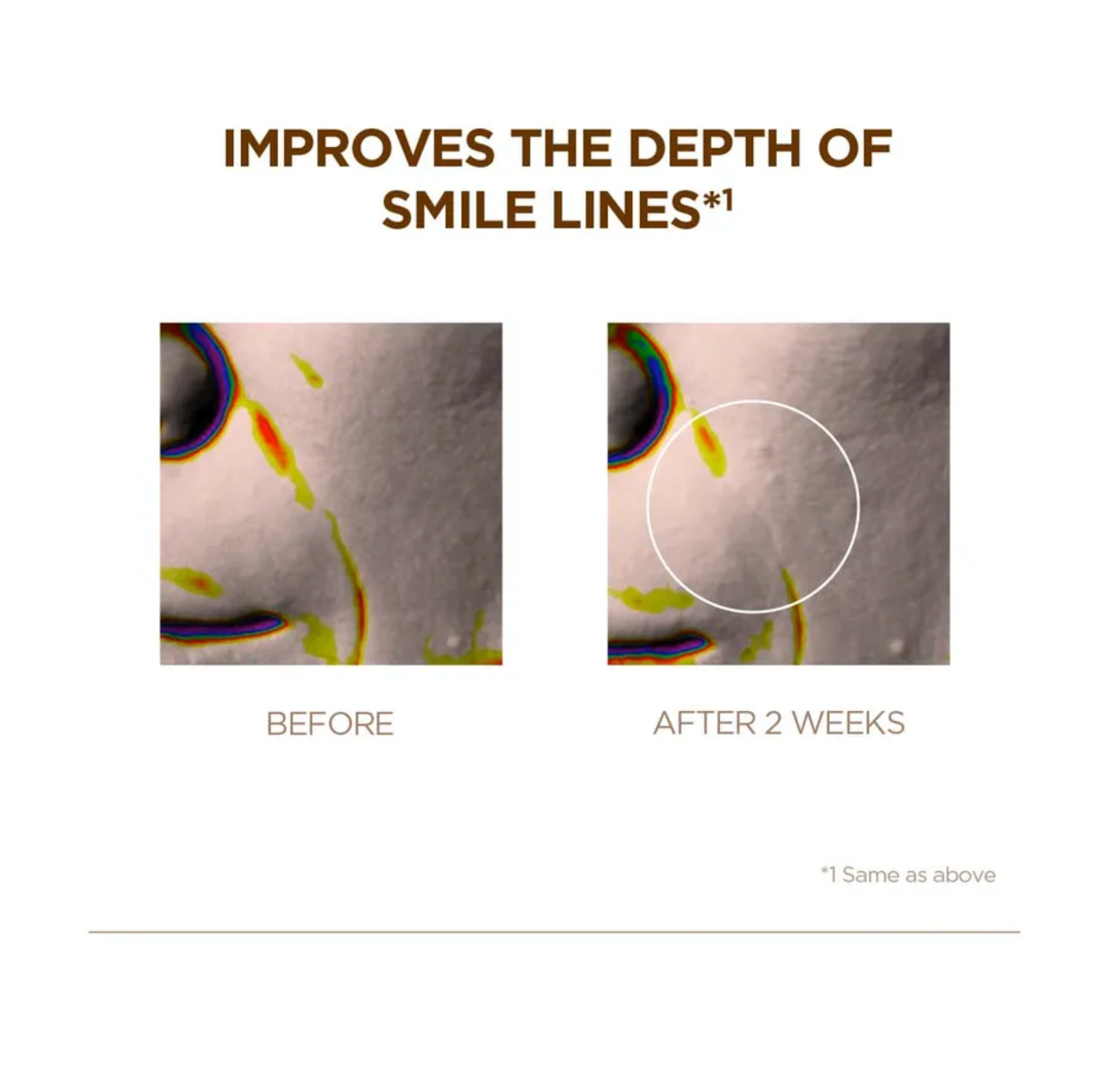 Before and after comparison of smile lines on skin with text indicating improvement.
