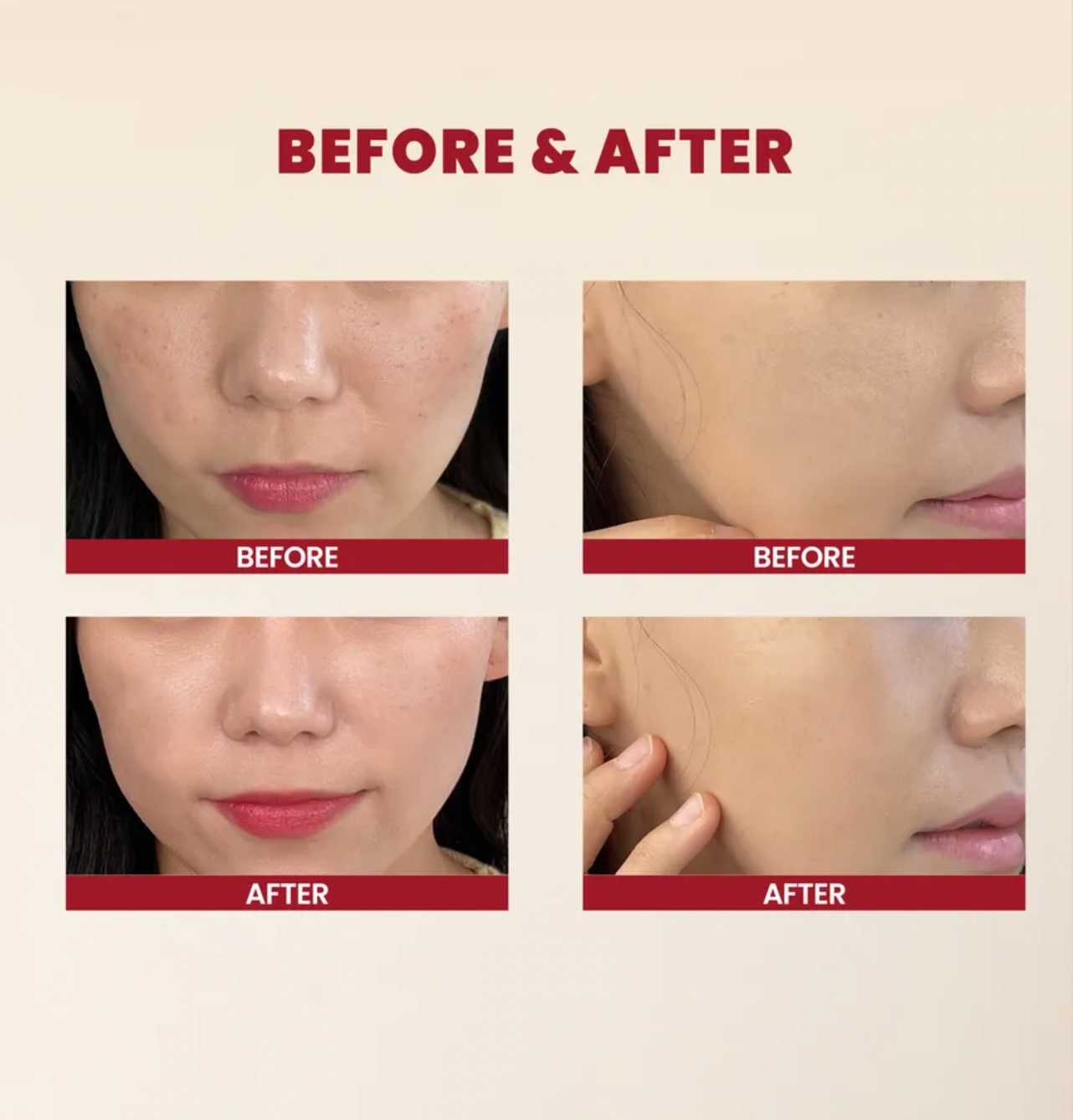 Before and after comparison of skin treatment on a beige background with 'Before' and 'After' labels.