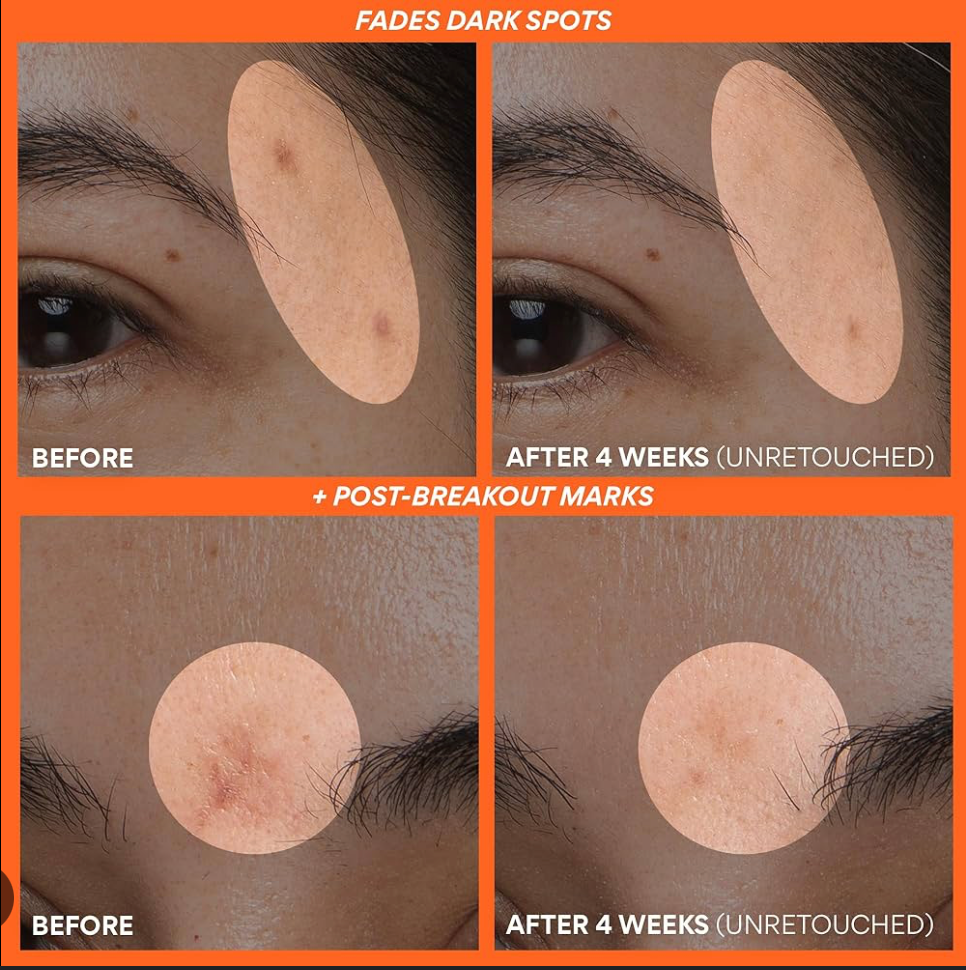 Before and after comparison of dark spots on skin with a neutral background.