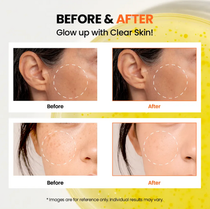 Before and after comparison of clear skin on a person's face with text 'Before & After Glow up with Clear Skin!'.