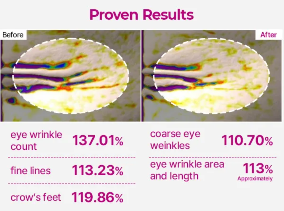 Before and after comparison of eye wrinkle count and other facial features with statistical percentages.