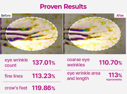 Before and after comparison of eye wrinkle count and other facial features with statistical percentages.